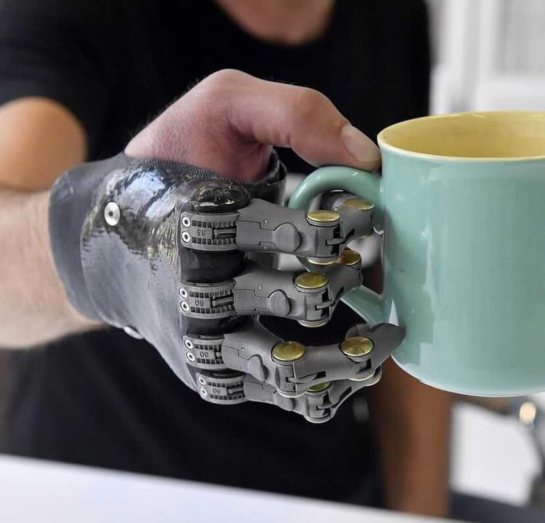 Patient holding mug with prosthetic fingers